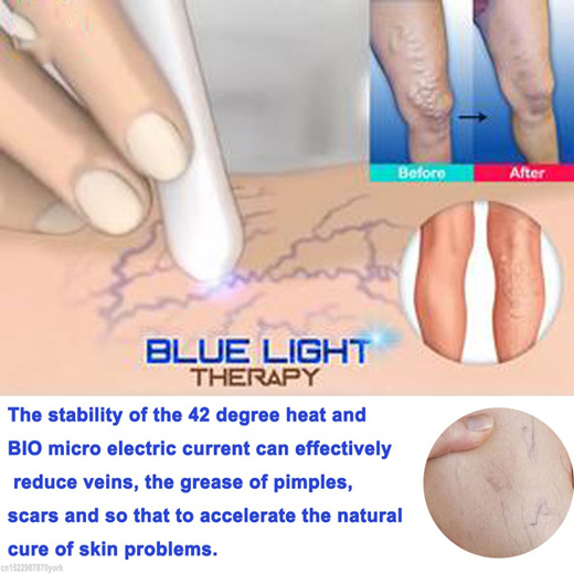 blue light vein removal