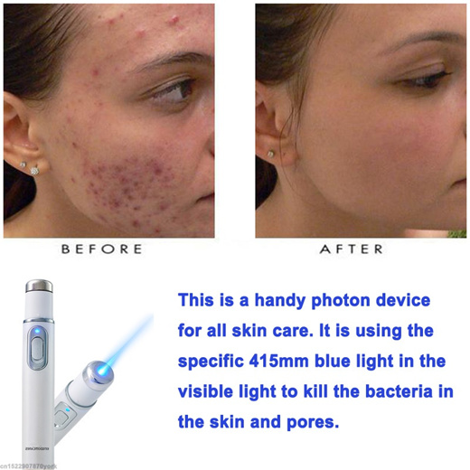 blue light vein treatment