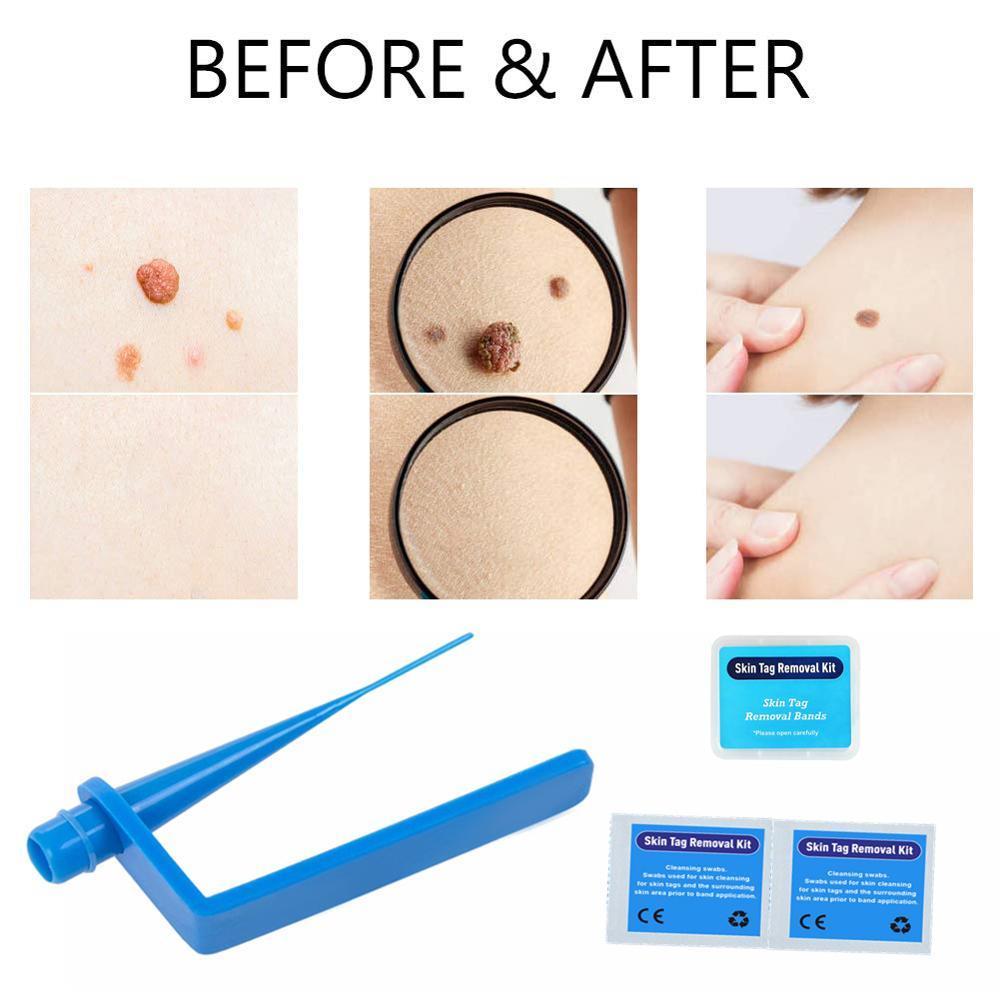 Qoo10 - skin tags remover remove warts body skin care tools wart ...